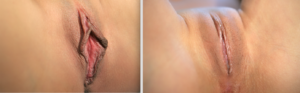 labiaplasty before and after