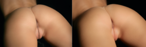 labiaplasty before and after