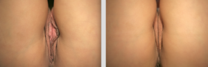 labiaplasty before and after