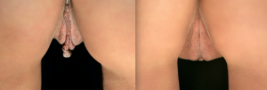labiaplasty before and after