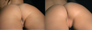 labiaplasty before and after