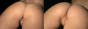 labiaplasty before and after