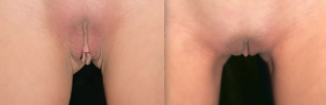 labiaplasty before and after