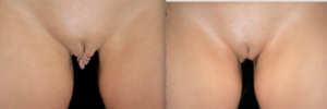 Labiaplasty Before and After Photo