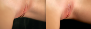 Labiaplasty Before and After Standing Up