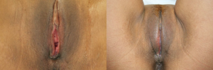 labiaplasty before and after