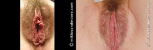 labiaplasty
