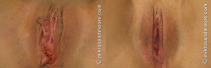 labiaplasty before and after