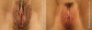 labiaplasty before and after