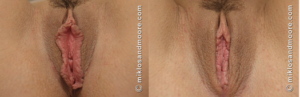 labiaplasty