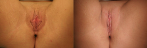 labiaplasty photo