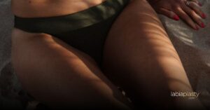 labiaplasty
