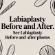 Labiaplasty Before and After: See labiaplasty before and after Photos