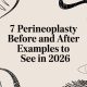 7 Perineoplasty Before and After Examples to See in 2026