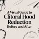 A Visual Guide to Clitoral Hood Reduction Before and After