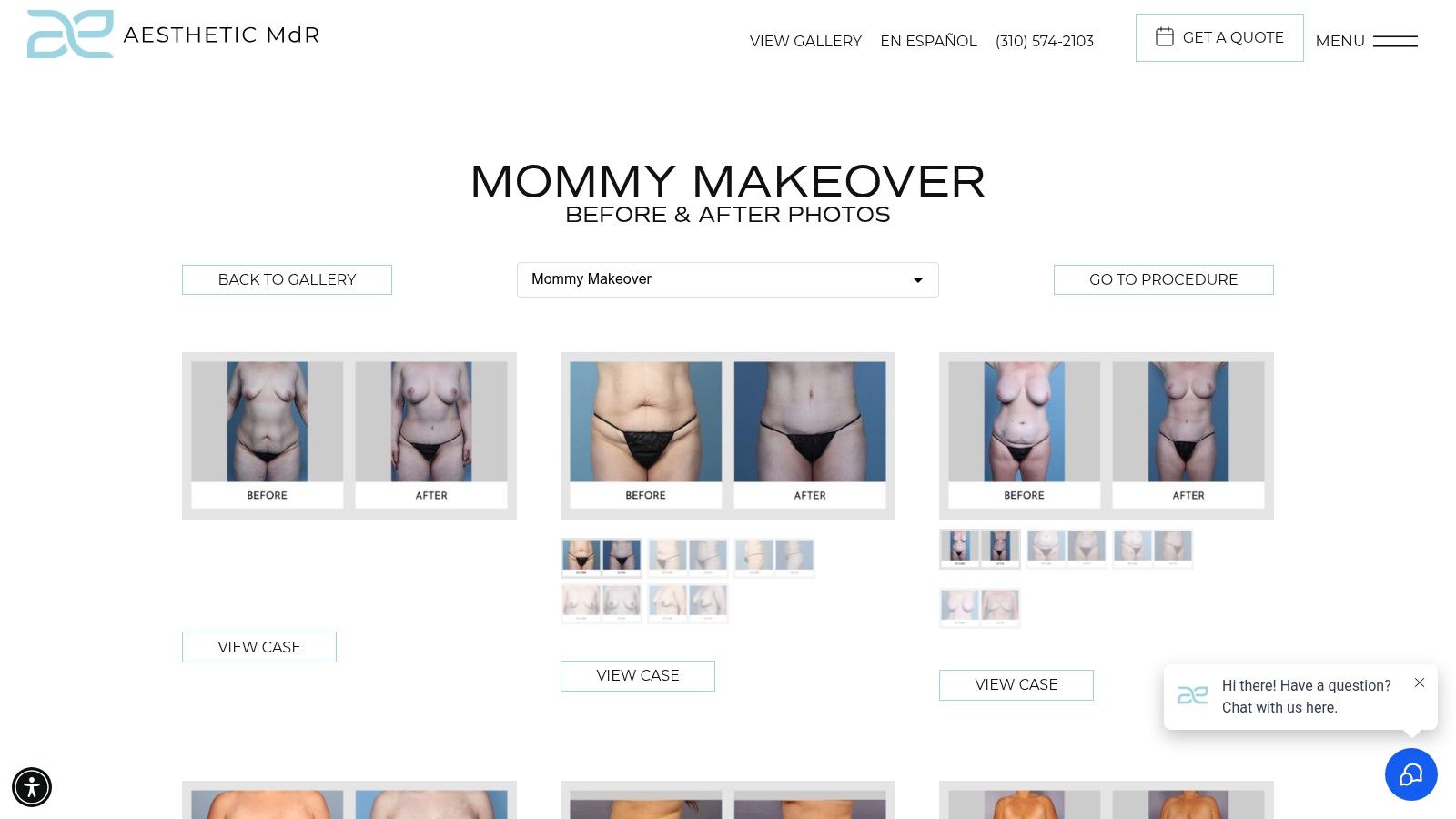 Aesthetic MD of Marina del Rey – Dr. Luis Macias – Mommy Makeover Gallery