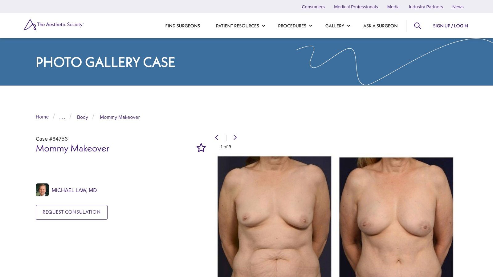 The Aesthetic Society – Mommy Makeover Case Gallery