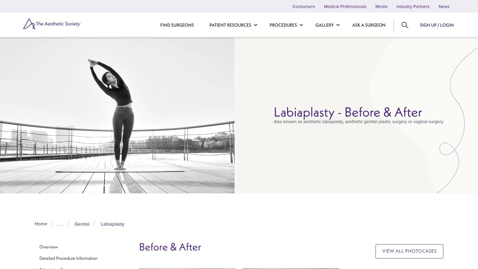 The Aesthetic Society – Labiaplasty Before & After Gallery