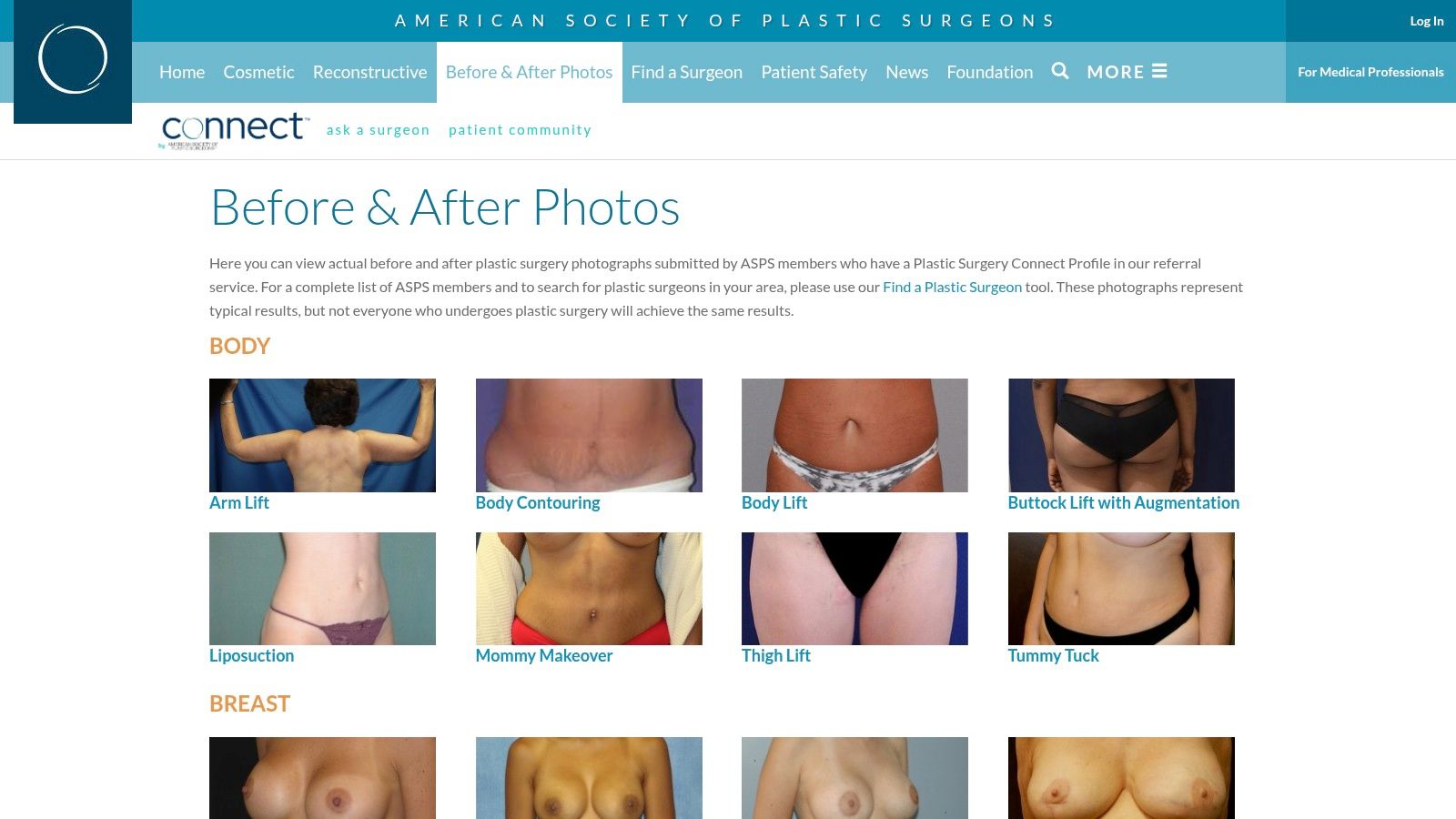 American Society of Plastic Surgeons (ASPS) – Public Before & After Gallery