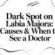 Dark Spot on Labia Majora: Causes & When to See a Doctor
