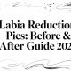 Labia Reduction Pics: Before & After Guide 2026