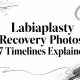 Labiaplasty Recovery Photos: 7 Timelines Explained
