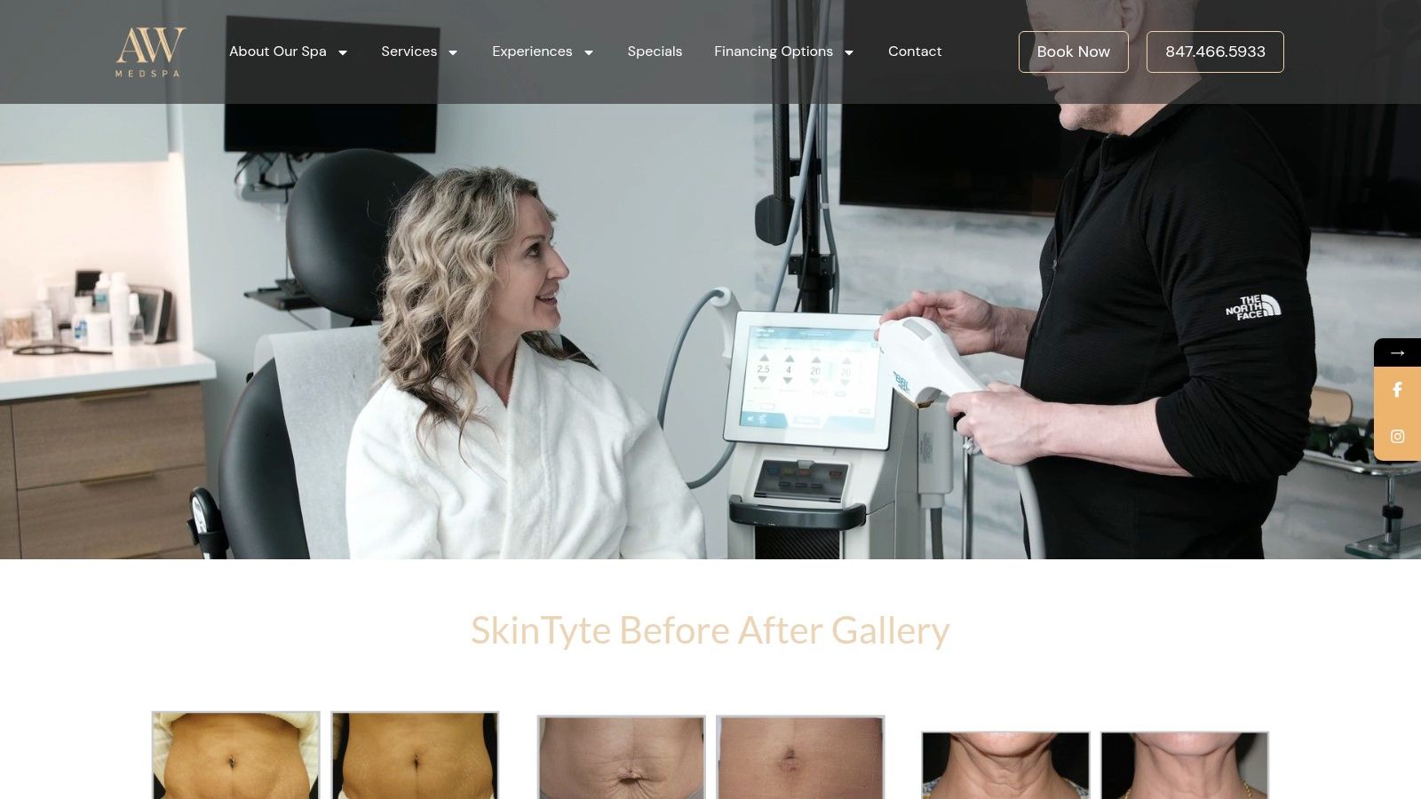 AW Medspa – SkinTyte before‑and‑after gallery