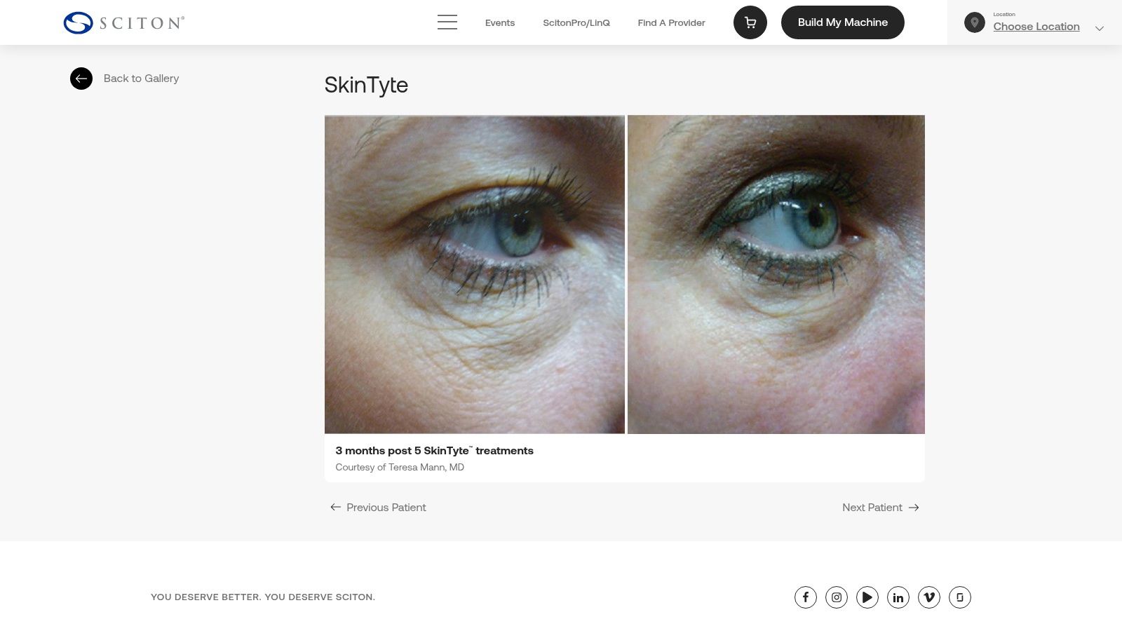 Sciton – SkinTyte official before‑and‑after gallery