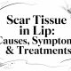 Scar Tissue in Lip: Causes, Symptoms & Treatments