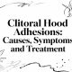 Clitoral Hood Adhesions: Causes, Symptoms, and Treatment