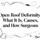 Open Roof Deformity: What It Is, Causes, and How Surgeons